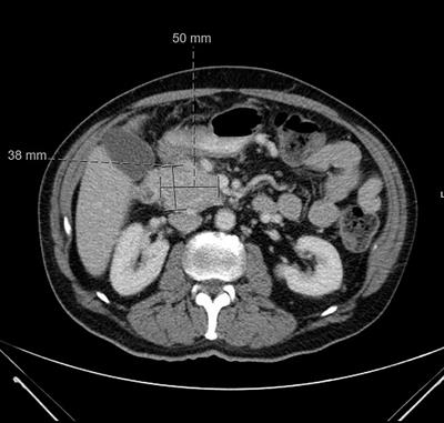 Hypercalcemia of malignancy caused by parathyroid hormone-related peptide-secreting pancreatic neuroendocrine tumors (PTHrP-PNETs): Case Report